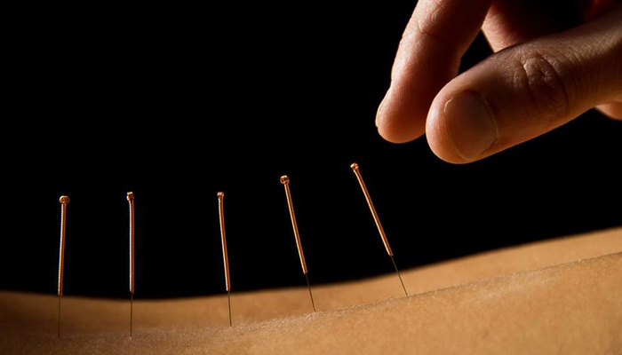 Reasons-You-Should-Visit-An-Acupuncturist